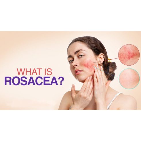 fito.C -5,2% Rosacea Complex Serum - Rozácea Komplex Szérum, 30ml
